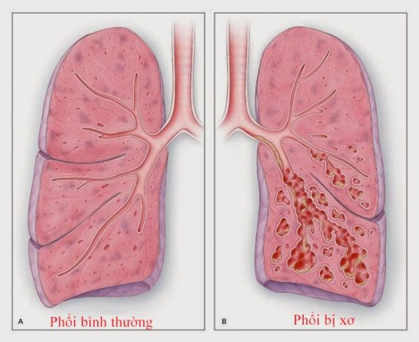 Xơ phổi là bệnh nguy hiểm gây sẹo tiến triển ở phổi