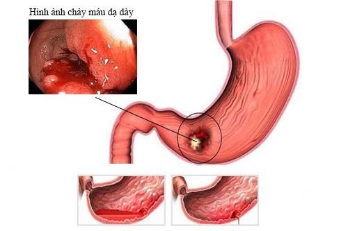 Tùy vào tình trạng và mức độ xuất huyết mà có biện pháp xử trí phù hợp