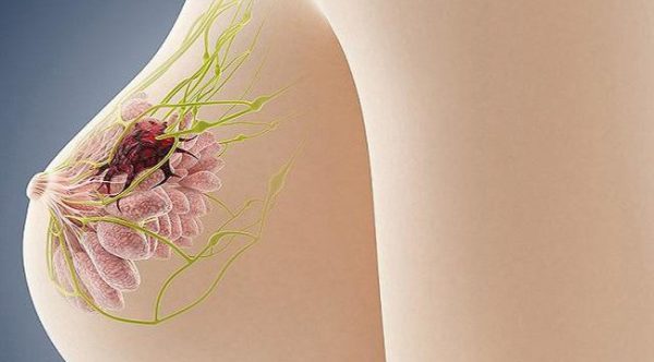 Giải pháp hút chân không u xơ vú