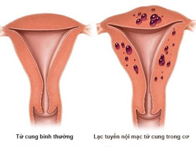 Hiện tượng lạc nội mạc tử cung ở phụ nữ là tác nhân gây tắc vòi trứng