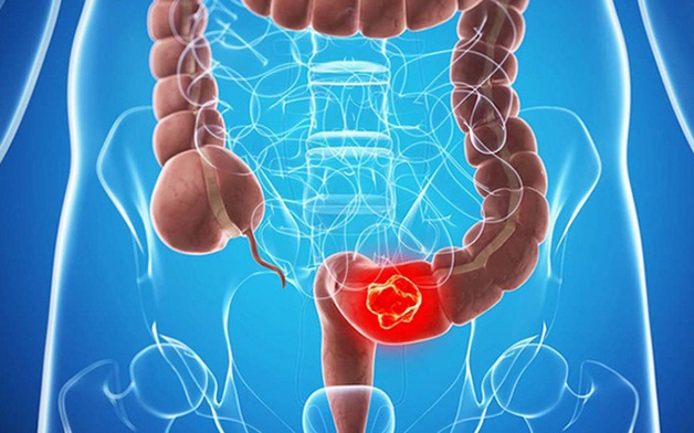 3. Triệu chứng của ung thư đại tràng sigma