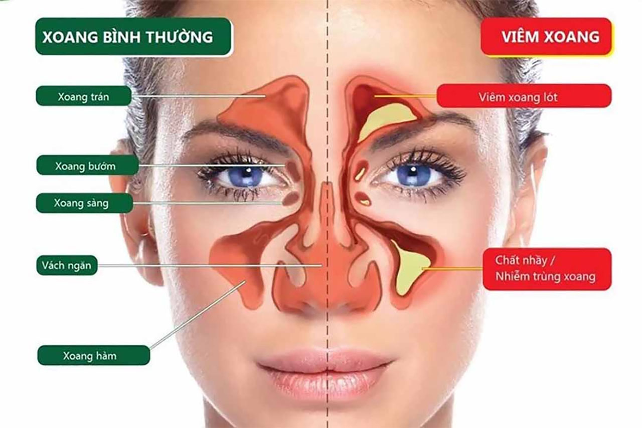 Bệnh viêm xoang mũi có nguy hiểm không và nguyên tắc điều trị