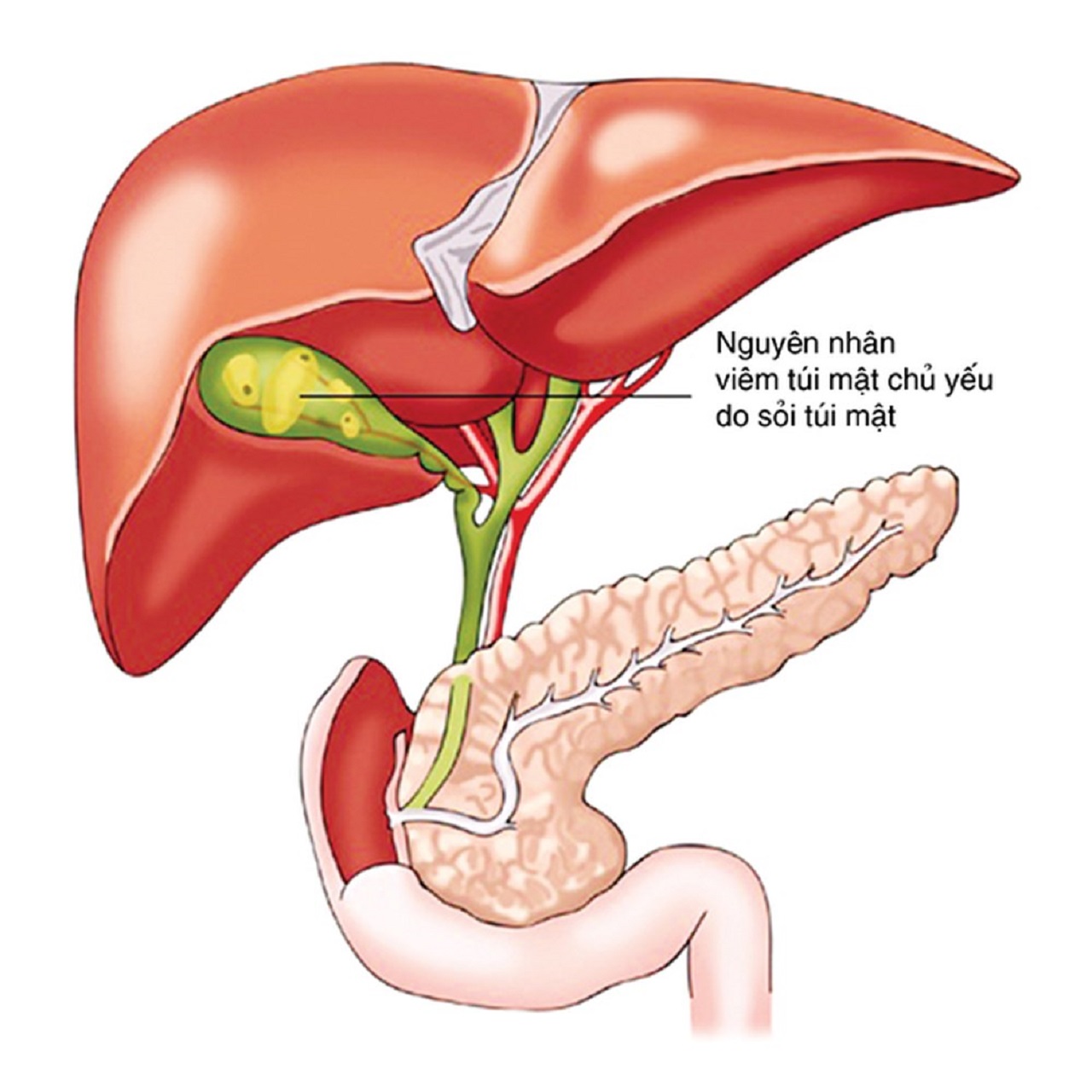 Cách điều trị viêm túi mật bằng thuốc là gì? 
