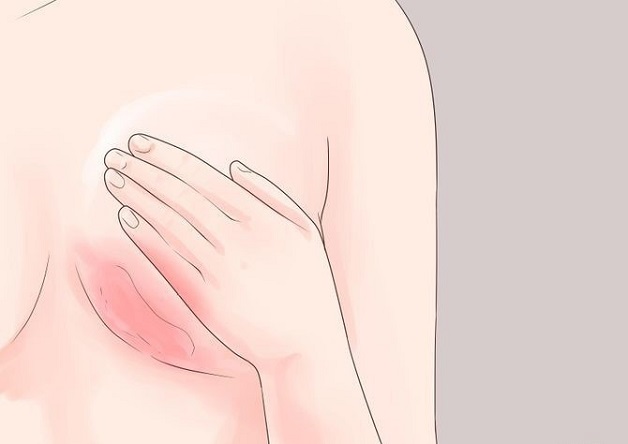 Cách điều trị ung thư vú giai đoạn đầu - triệu chứng