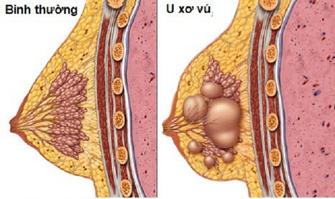 Quy trình sinh thiết tuyến vú có đau không?
