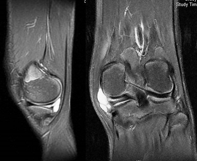 Chụp MRI đầu gối giúp phát hiện tổn thương ở xương, sụn, dây chằng,...trong trường hợp các phương pháp khác tiếp cận còn hạn chế