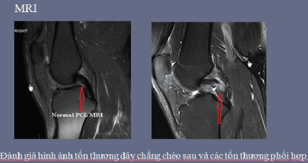 chụp mri khớp gối bao nhiêu tiền