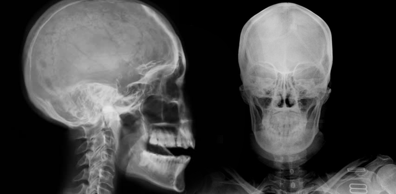 Quy trình chụp X-quang sọ não diễn ra như thế nào? | TCI Hospital