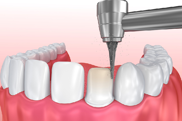 Bọc răng sứ sần phải mài nhỏ răng thật, làm mất đi nhiều mô răng mà không thể khôi phục lại được.