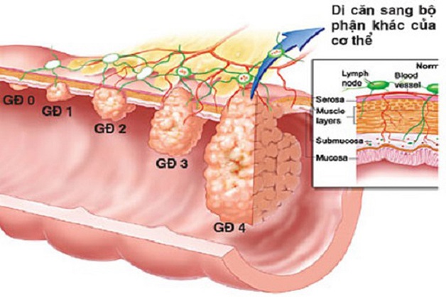 Nhận biết các dấu hiệu ung thư dạ dày giai đoạn cuối | TCI Hospital