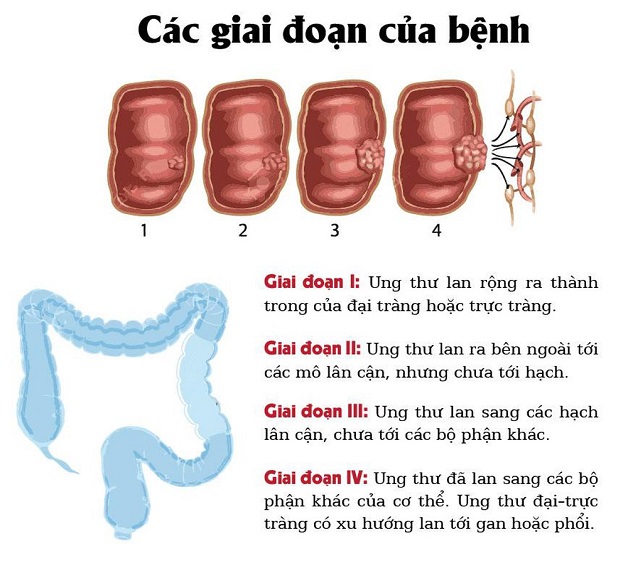 4. Phương Pháp Điều Trị Ung Thư Đại Tràng