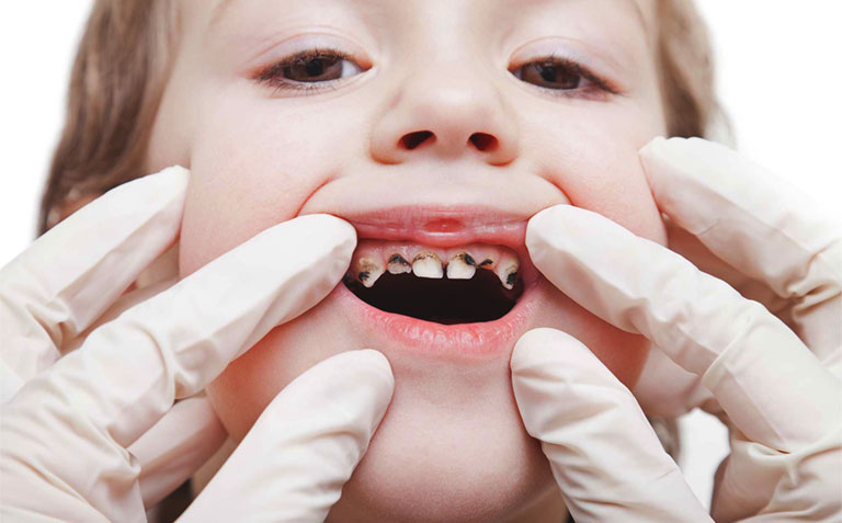 Vì sao cần hàn răng sâu cho trẻ em? | TCI Hospital