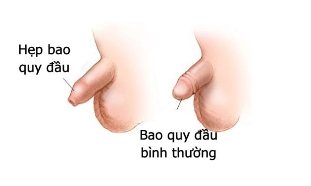 Hẹp bao quy đầu ở trẻ em là tình trạng thường gặp ở các bé trai, chiếm khoảng 96% hiện nay, hiện tượng này thường kết thúc khi trưởng thành.