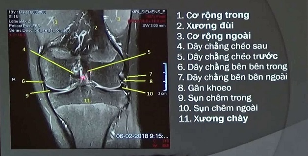 Kỹ thuật chụp MRI khớp gối được thực hiện như thế nào?