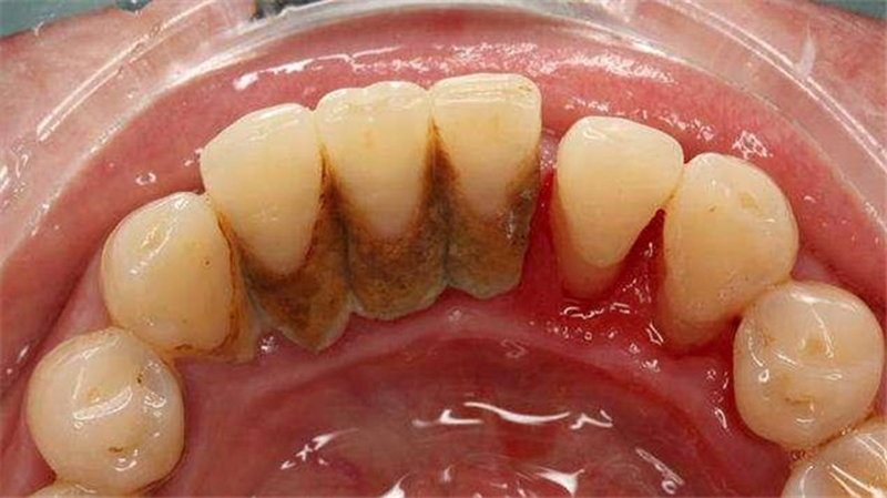 Quy trình lấy cao răng như thế nào? | TCI Hospital