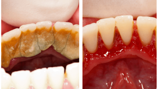 Sự khác biệt trước và sau khi lấy cao răng