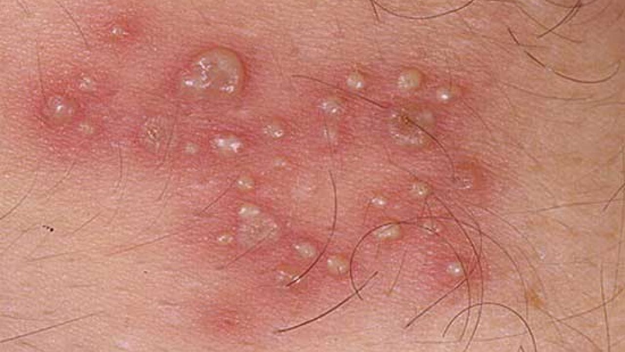 Người mắc herpes có thể lây cho người khác không?
