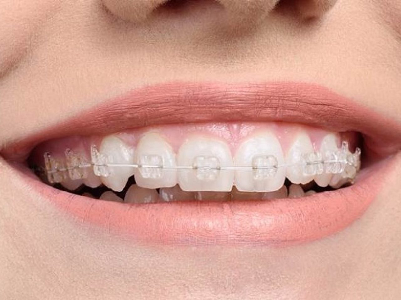 Niềng răng mắc cài sứ có giới hạn tuổi không?