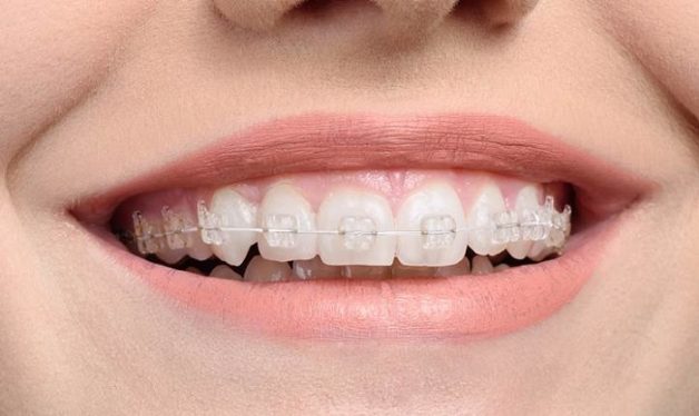 Niềng răng bằng mắc cài sứ được đánh giá cao về tính thẩm mỹ vì sứ có màu sắc tự nhiên như răng thật