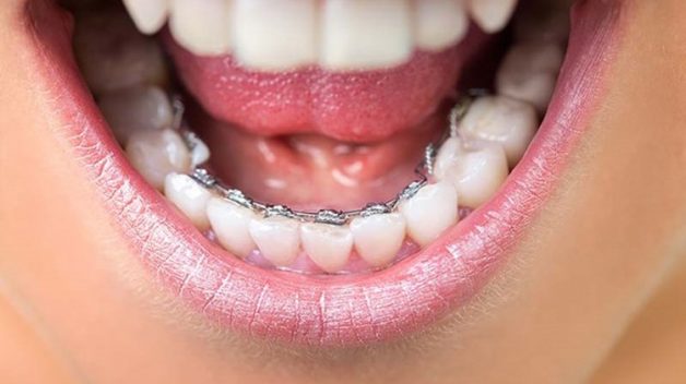 Niềng răng mặt lưỡi là phương pháp có mắc cài được gắn ở mặt trong của răng chính vì vậy sẽ mang đến tính thẩm mỹ cao