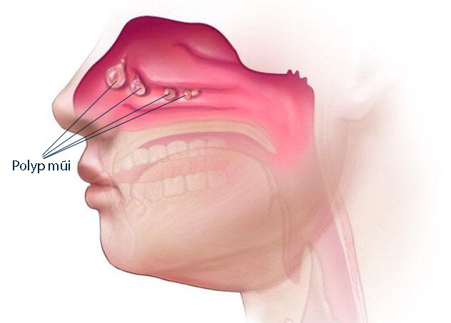 Polyp mũi là một trong các trường hợp được chỉ định phẫu thuật nội soi mũi xoang để điều trị triệt để