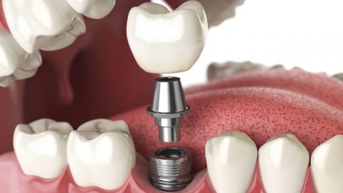 Tìm hiểu chi tiết quy trình trồng răng implant