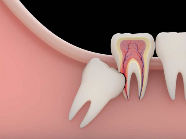 Răng số 8 mọc khi nào: Những điều cần biết về quá trình mọc răng khôn