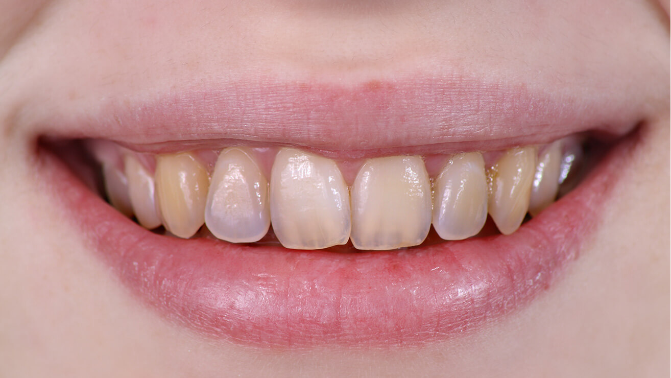 Khi đã thực hiện tẩy trắng răng nhưng không hiệu quả, bác sĩ sẽ thực hiện lắp răng sứ cho bệnh nhân
