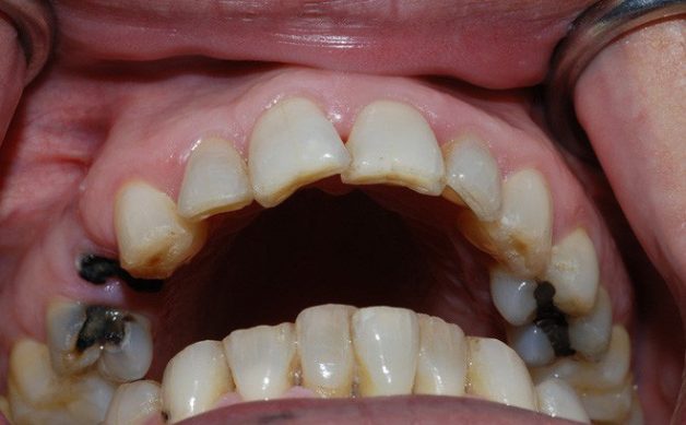 Sâu răng gây mất thẩm mỹ và ảnh hưởng đến chức năng ăn nhai. Chính vì vậy, bọc răng sứ là giải pháp hoàn hảo để khắc phục tình trạng này và phục hồi chức năng cho răng