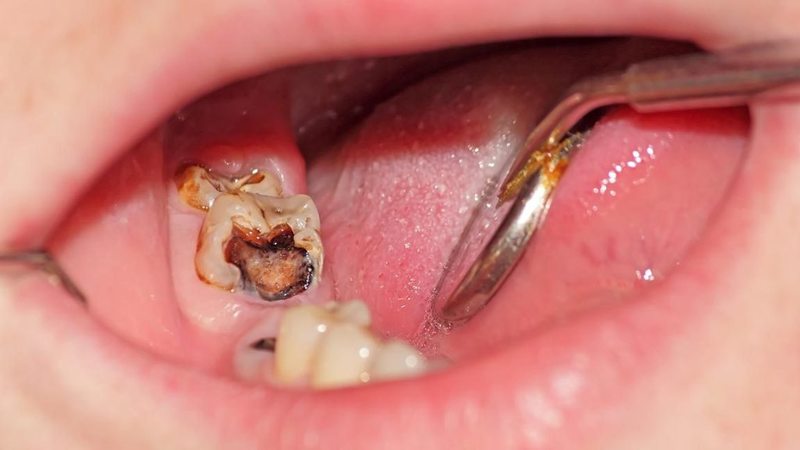 Sâu răng hàm có nên nhổ không?