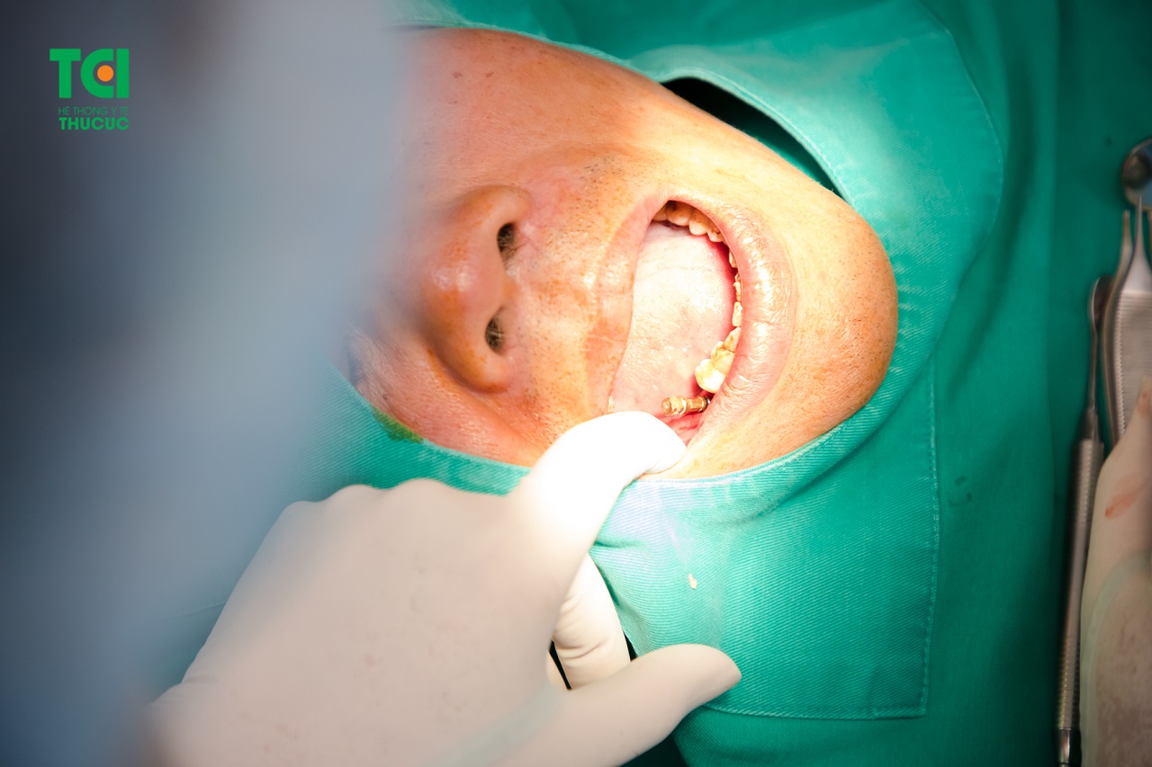 Thời gian hồi phục sau khi nhổ răng hàm dưới bị sâu là bao lâu?
