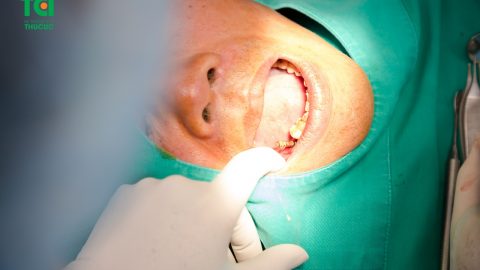 Sâu răng hàm có nên nhổ hay không?