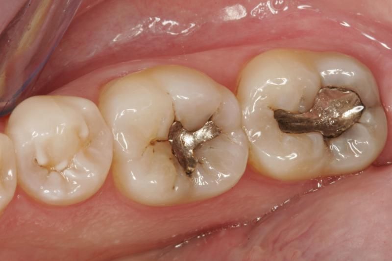 Răng hàm bị sâu được điều trị bằng trám răng 