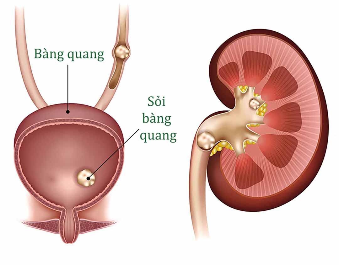 soi bang quang co nguy hiem khong 1