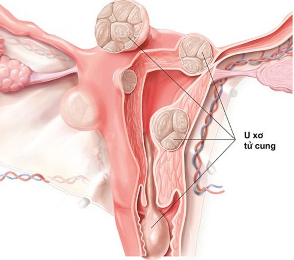 U xơ tử cung là một trong những nguyên nhân gây ra tình trạng tắc ống dẫn trứng