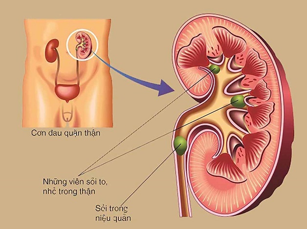 tan soi nieu quan ngoai co the 2