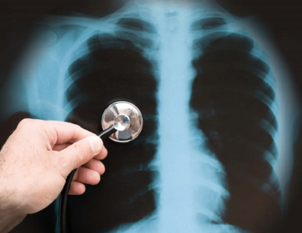 Chụp X quang phổi giúp chẩn đoán nhiều bệnh nguy hiểm