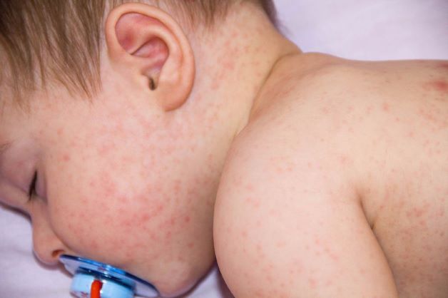 Trẻ bị sốt phát ban phải làm sao là thắc mắc của rất nhiều bậc phụ huynh có con nhỏ