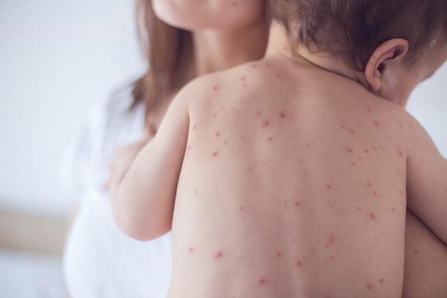 Trẻ bị sốt phát ban do virus tấn công và gây ra tình trạng nổi các ban đỏ như: virus sởi, Rubella hoặc virus đường ruột Echo gây ra. 