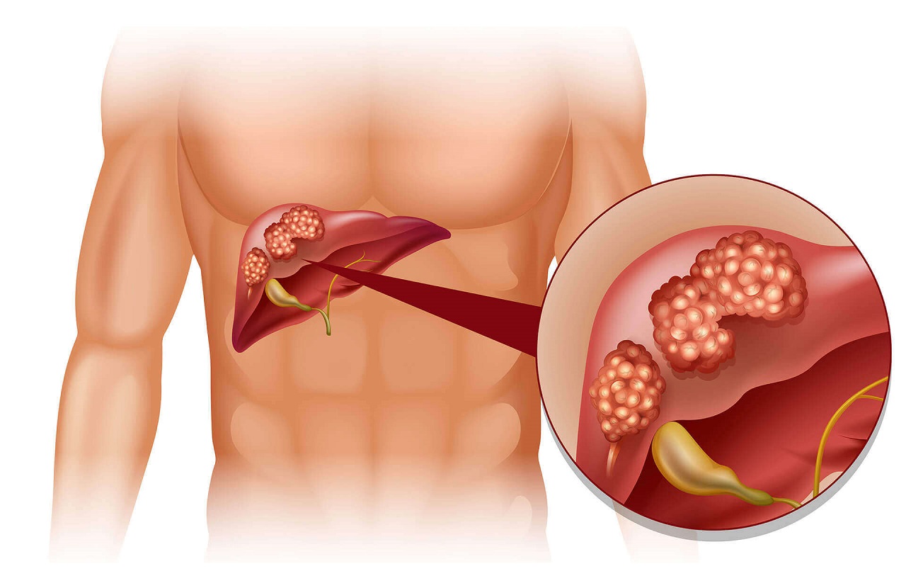 Các biểu hiện của bệnh gan giai đoạn cuối – Những điều cần biết