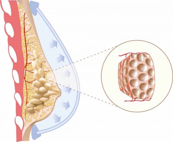 U nang tuyến vú là hiện tượng xuất hiện khối dịch lỏng ở bên trong vú.
