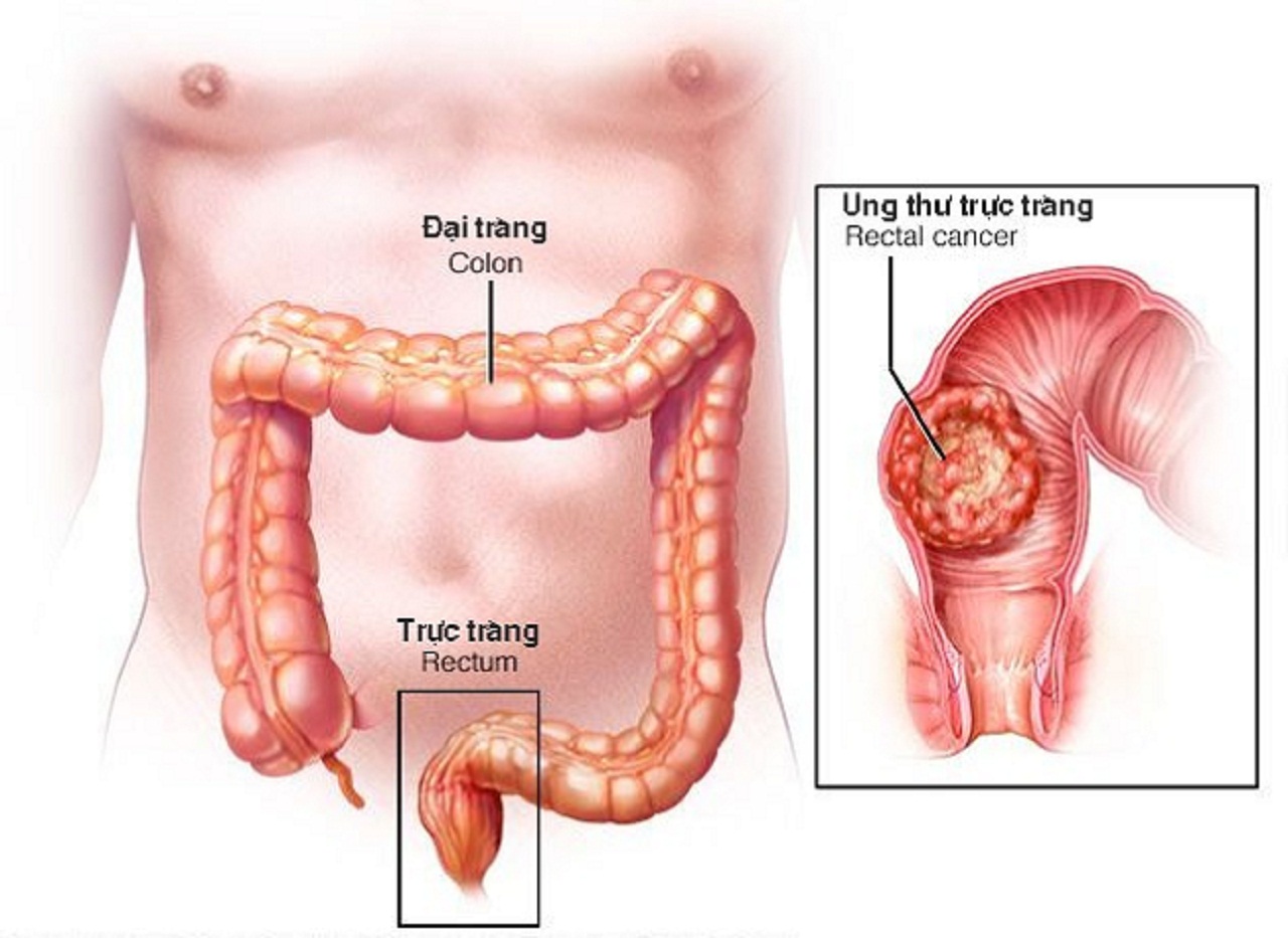 Chuyên trang bệnh u trực tràng Thông tin và cách chữa trị hiệu quả