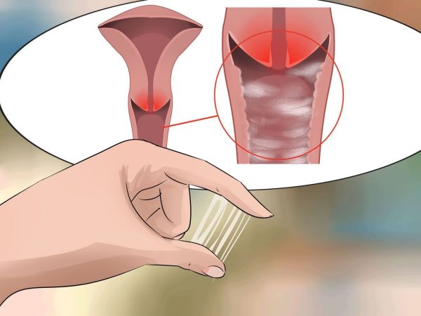 Viêm cổ tử cung khi mang thai 3 tháng cuối là hiện tượng sưng, viêm hay lở loét do nhiễm khuẩn, nấm hoặc ký sinh trùng gây ra