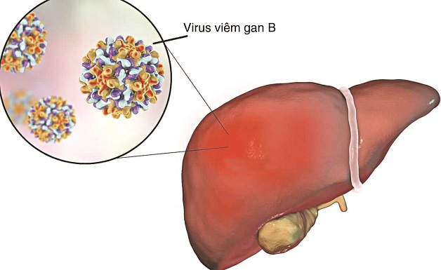 Viêm gan B là bệnh gây ảnh hưởng nhiều cho gan