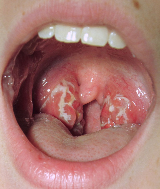 Viêm họng liên cầu gây tổn thương họng và các cơ quan xung quanh
