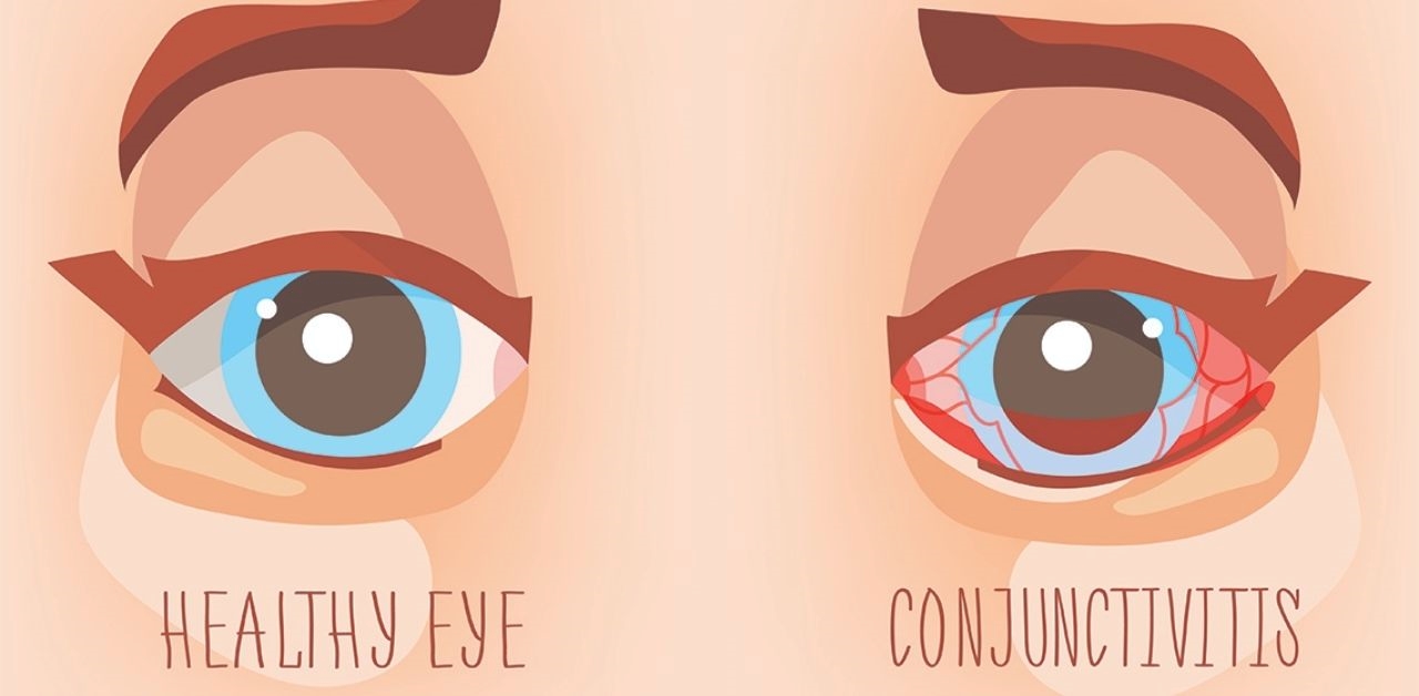 Nguyên nhân và cách phòng tránh mắt bị viêm kết mạc 