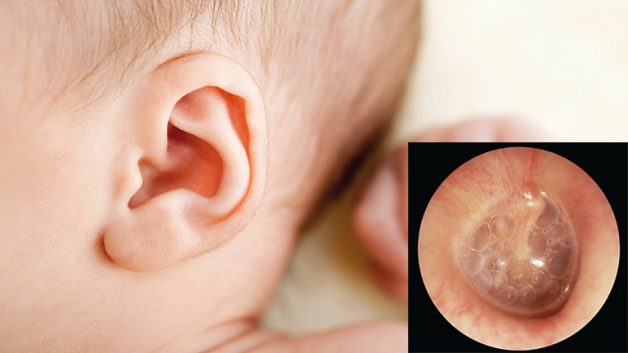 Viêm tai giữa ứ dịch là căn bệnh nhiều trẻ em gặp phải