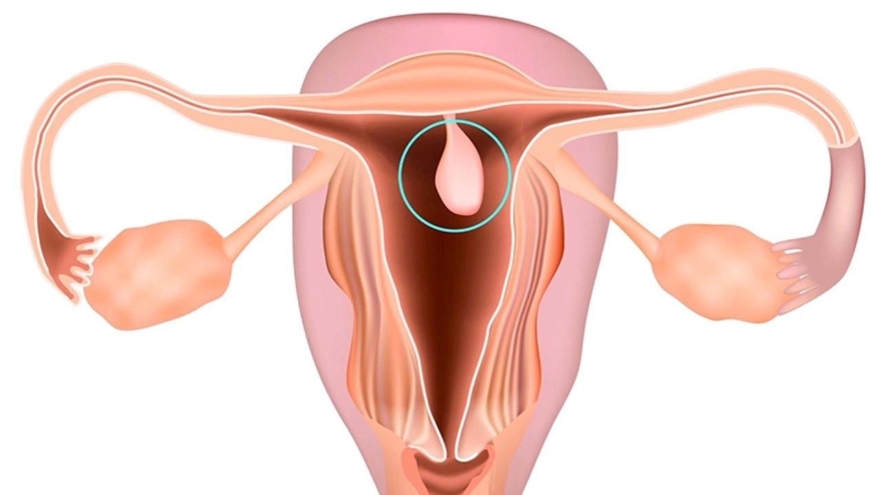 Tác dụng phụ và biến chứng có thể xảy ra sau phẫu thuật cắt polyp tử cung?
