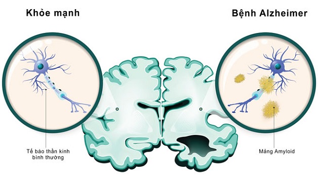 Alzheimer có di truyền không? Khám Phá Những Yếu Tố Ảnh Hưởng Đến Bệnh