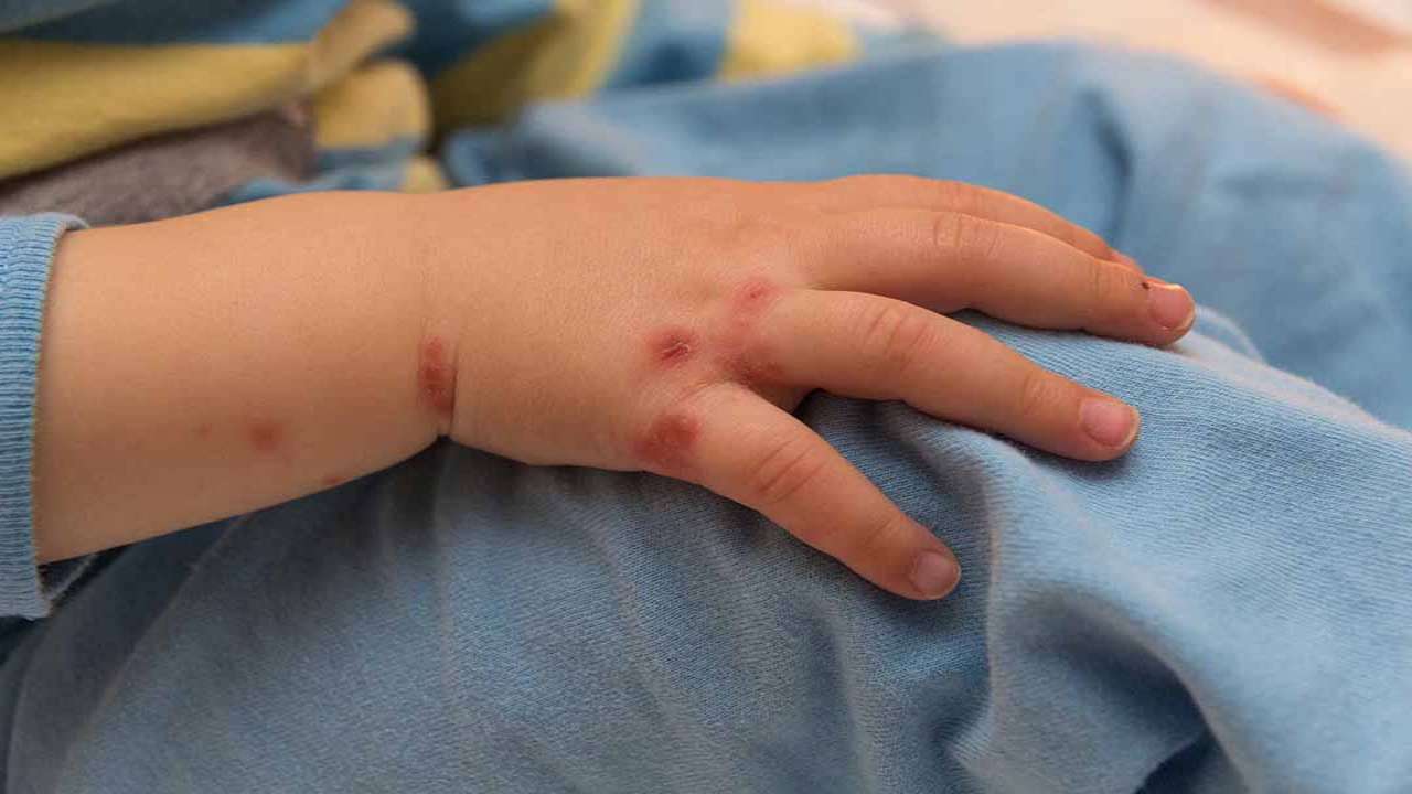 Tại sao trẻ em dễ mắc bệnh tay chân miệng hơn?
